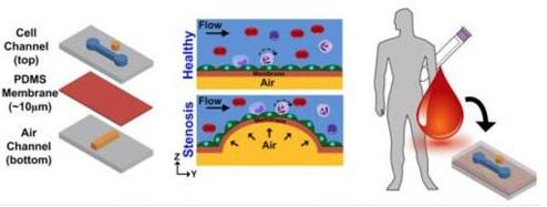 在芯片上實(shí)現(xiàn)動(dòng)脈粥樣硬化的模擬，并在心臟病發(fā)作前評(píng)估血管的狹窄和血液的健康狀況