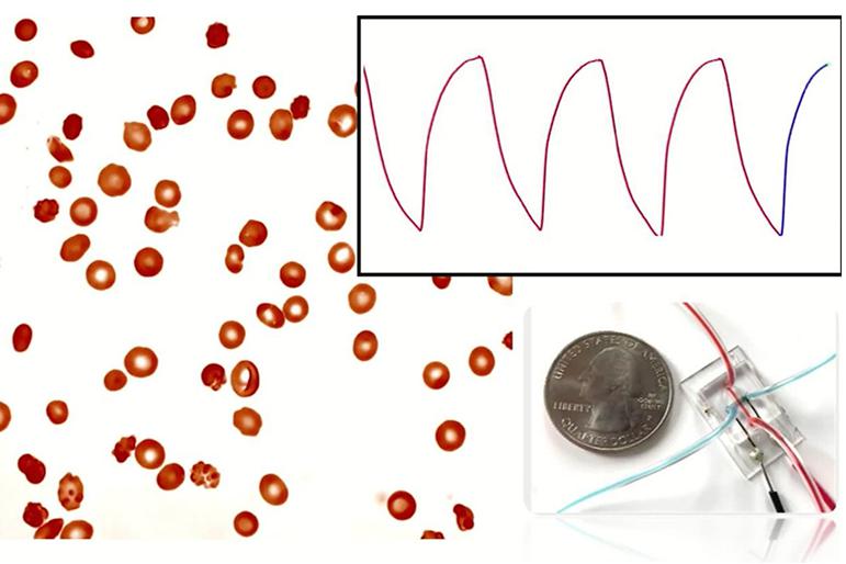 微流控阻抗傳感器可以監(jiān)測鐮狀細(xì)胞病