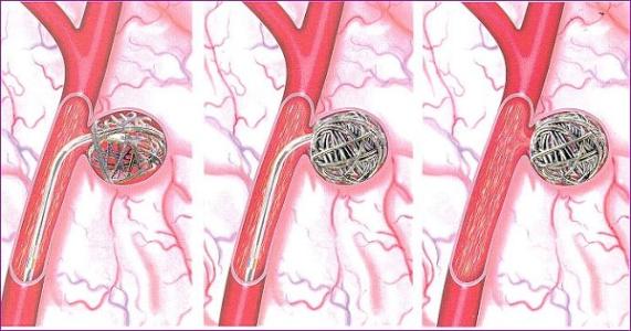 可拉伸的無線傳感器可以監(jiān)測腦動脈瘤的愈合