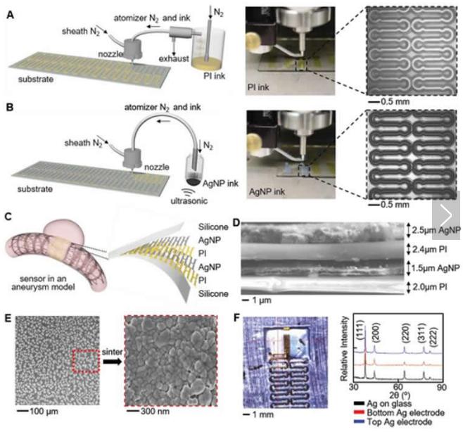 可拉伸的無線傳感器可以監(jiān)測腦動脈瘤的愈合