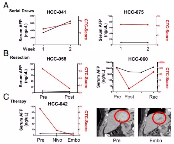 圖4.CTC評分較血液AFP檢測系統(tǒng)能夠更靈敏、更特異地檢測肝癌及監(jiān)控肝癌的治療情況。